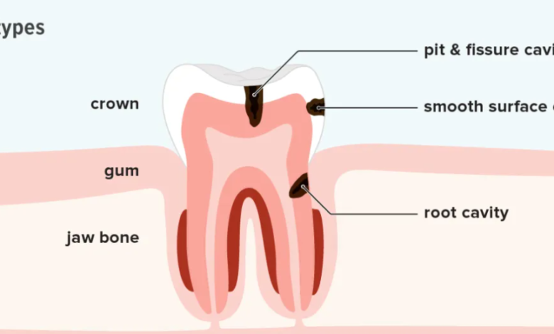 Cavity Treatment