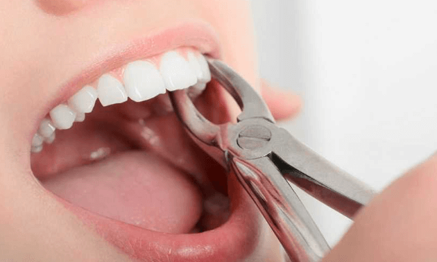 Understanding Tooth Extraction: When It Is Necessary?