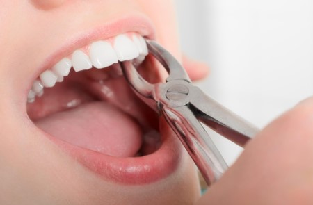 Teeth Extraction