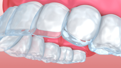 Who is Invisalign Ideal for?