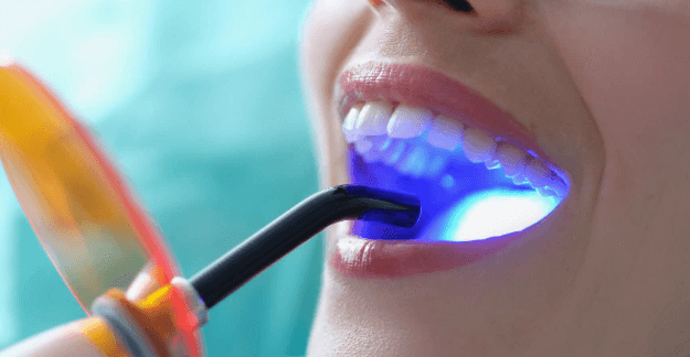 Which is The Most Permanent Teeth Whitening Procedure?