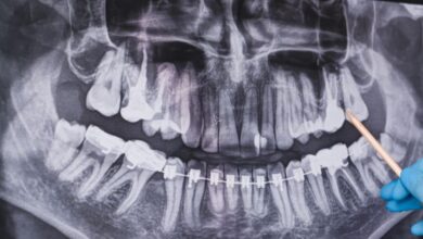 Periapical X-Rays