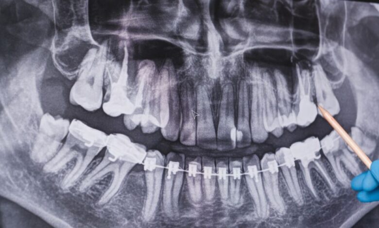 Periapical X-Rays