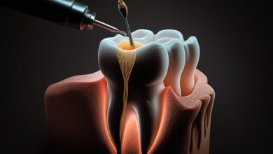 Root canal therapy