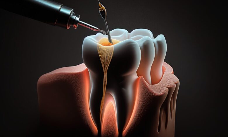 Root canal therapy