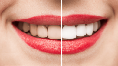 The Surprising Ways Your Diet Could Be Staining Your Teeth