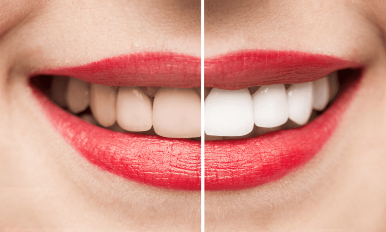 The Surprising Ways Your Diet Could Be Staining Your Teeth